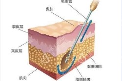 吸脂技术哪种最先进？效果和安全性如何？