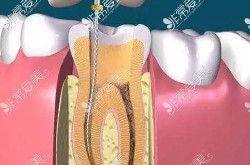 根管治疗后悔一辈子是真的吗？有哪些替代方案？