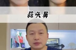 蒜头鼻整形前后对比明显吗？效果能维持多久？