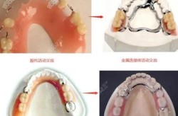 镶牙材料哪种好？镶牙过程是怎样的？