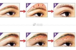 切眉和提眉手术，哪个效果更自然？如何抉择？