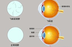 飞蚊症手术需要多少钱？治疗靠谱吗？