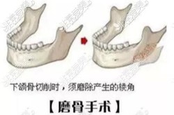 削骨手术过程是怎样的？有哪些风险和注意事项？