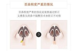 北京歪鼻矫正手术多少钱？术后需要注意什么？