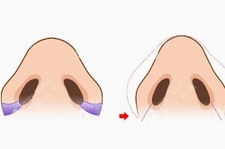 鼻翼缩小手术真的安全吗？有哪些风险需注意？