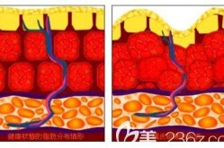 超声波吸脂手术的原理是什么？效果怎么样？