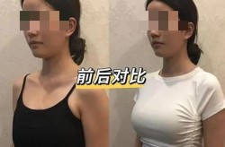 自体脂肪隆胸和假体隆胸哪个更自然？如何选择？