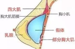 假体隆胸手术的安全性怎样？有哪些注意事项？