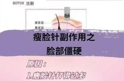 打瘦脸针需要注意哪些事项？有没有副作用？