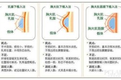 假体隆胸手术哪里好，术后护理怎么做？