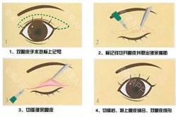 怎样变成双眼皮最自然，手术和非手术哪个更好？