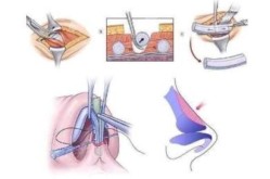 自身软骨隆鼻有哪些优点？手术过程复杂吗？