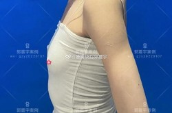 北京自体脂肪隆胸效果如何？手术风险大吗？