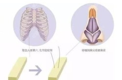 软骨隆鼻手术价格疑问：大概需要多少钱才能拥有美鼻？