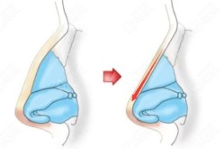驼峰鼻矫正手术价格揭秘：需要多少费用？
