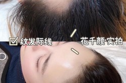 植发手术10元20元的差别是什么？如何评估性价比？