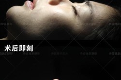 隆鼻术医院如何挑选？哪些因素决定手术效果？