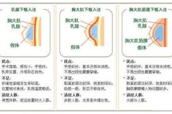 假体隆胸优势有哪些？和自体脂肪隆胸比哪个更适合？