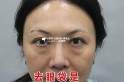 眼袋吸脂术安全吗？有哪些术后护理注意事项？