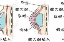 隆胸整型有几种方法？哪种更适合我？