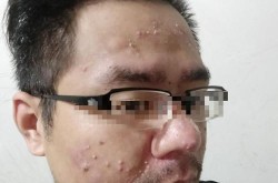 光动力疗法治疗痘痘效果如何？费用高吗？