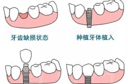 种一颗牙齿的费用大概是多少？种牙过程复杂吗？