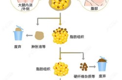 自体脂肪丰胸会有哪些副作用？如何降低风险？