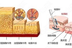 吸脂手术哪里做得好？有没有失败案例？