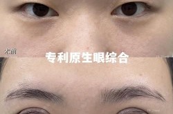 眼睛整形开眼角会留疤痕吗？术后恢复怎样？