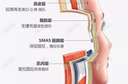 面部除皱方法哪种最有效？有没有无创除皱技术？