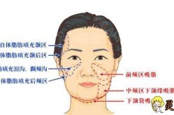 面颊部吸脂术后如何护理？有哪些注意事项？