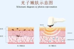 光子嫩肤去哪里做好？效果可以维持多久？