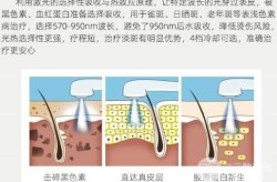 激光除皱的费用是多少？除皱后有哪些注意事项？