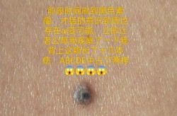 黑色素痣切除手术费用一般多少？哪家医院做得好？