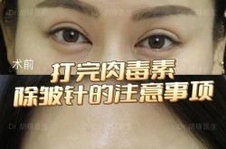 微创面部除皱术痛不痛？效果能维持多久？