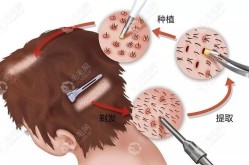 植发哪里效果好？植发手术有哪些注意事项？