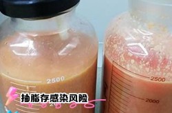 吸脂整形价格一般是多少？有没有副作用？