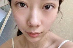 北京割双眼皮哪里技术最好？术后恢复如何？