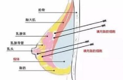 丰胸手术的费用大概是多少？手术风险有哪些？