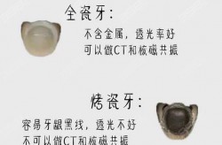 装一个假牙多少钱算合理？如何挑选假牙材料和医生？